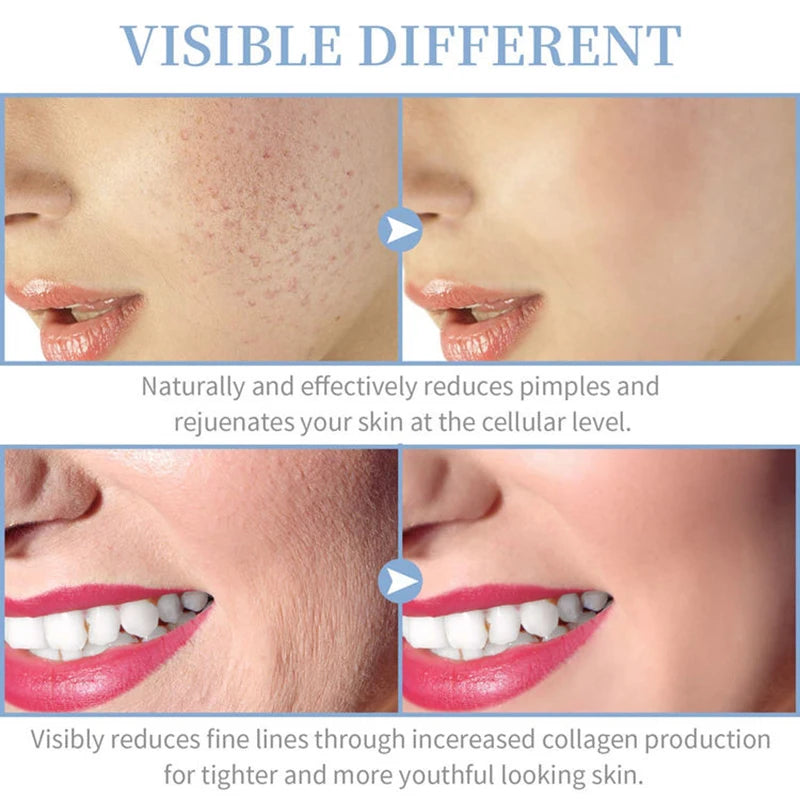 Botavie Skin™ Acne Control & Skin Renewal